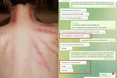 Bạn gái cởi áo để anh kết nghĩa cạo gió