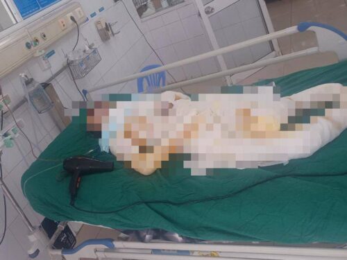 Vụ 3 con gái mang xăng đốt nhà mẹ: Người mẹ nhiễm trùng máu nặng, tiên lượng xấu