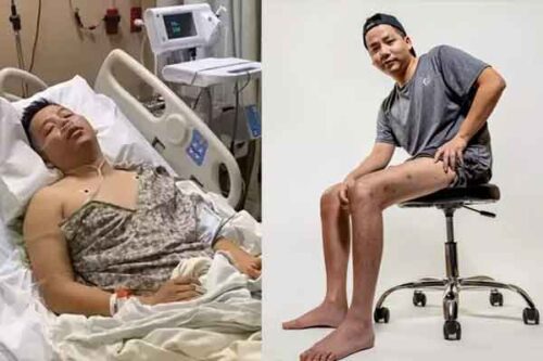 Giật mình đôi chân đầy sẹo Khoa Pug khi chi 5 tỷ tăng chiều cao