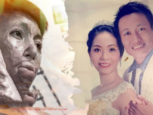 Cuối tháng 12/2022, người dân tại Biên Hoà (Đồng Nai) không khỏi xôn xao trước vụ việc chồng tự tay tẩm xăng, thiêu sống vợ chỉ vì ghen tuông vô cớ. Song hắn lại chính là người kêu cứu, cầu xin mọi người hãy đưa vợ đến bệnh viện cấp cứu. “Tôi không phải người chứng kiến, nhưng được nghe người ta kể lại rằng bữa đó vì ghen tuông mà gã chồng “xuống tay” với chính người “đầu ấp tay gối” hơn chục năm. Hắn đã bị phần thú tính lấn át rồi bừng tỉnh nhưng đã quá muộn. Còn người vợ đã trải qua hàng chục cuộc phẫu thuật đắp da, nối gân vì bị tổn thương trầm trọng. Giờ chỉ cần hỏi chị Linh bị tẩm xăng là ai ở xứ này cũng biết, bày tỏ sự xót xa”, một người dân sinh sống tại thành phố Biên Hoà cho biết. Chị Linh - nhân vật chính trong câu chuyện trên hiện sống cùng 3 đứa con trong căn phòng rộng hơn chục mét vuông, bên trong không có thứ gì đáng giá. Chị cho biết: “Đây là nhà của mấy mẹ con em. Nó giống như phòng trọ nhưng đã được anh trai em mua và tặng cho em. Bữa em nằm viện, gia đình không xoay đủ tiền đã định bán đi để lo. Nhưng nhờ sự giúp đỡ của họ hàng, các y bác sĩ mà em giữ lại được, giờ 4 mẹ con mới có chỗ ở”. ADVERTISING Hình ảnh chị Linh ngày xưa và hiện tại. Nói xong, người phụ nữ Đồng Nai đưa đôi bàn tay chằng chịt sẹo quệt quệt lên mặt. Sau đó chị bảo do da đang căng nên thi thoảng rất ngứa, không chịu được nên phải gãi cho đỡ bứt rứt. “Xưa em cũng gọi là người có nhan sắc, da trắng, gương mặt hài hoà… Vậy mà giờ đây em “thay đổi” quá nhiều: hai cánh tay cong queo, nhiều sẹo, mặt biến dạng, cổ sần sùi. Mỗi lần em soi gương cứ ngỡ bản thân là người khác, chứ không phải là mình của xưa kia”, chị Linh rơi lệ. Nhắc đến nguyên do chồng ra tay tàn độc với mình, chị Linh cho biết ngày 13/12, chồng lấy xe máy đi làm nên không có phương tiện chở quần áo ra chợ bán. Vì thế chị có nhờ chồng của một bà chị lên chở hộ. Buổi trưa, anh này chở bao tải quần áo từ nhà chị Linh xuống chợ. Chiều anh đã quay trở về đón chị xuống để bắt đầu bày hàng ra bán. Khi chị đang đi từ nhà vệ sinh ở chợ ra thì bất ngờ thấy ông xã cầm chai nước – cứ nghĩ là nước lá vối. Hắn hỏi chị người đàn ông chở xuống chợ là ai rồi lập tức tưới xăng khắp người chị, quẹt lửa ném vào và ngọn lửa bùng cháy. “Gần 18h, ông xã đi làm về không thấy em đâu nên hỏi hai đứa út: “Mẹ đâu?”. Chúng bảo có bác đến chở mẹ đi từ trưa. Thấy thế chồng em mới cầm chai đi mua xăng, chạy thẳng xuống chợ. Lúc vừa thấy em, anh chỉ tay về phía ông chồng của bà chị (người chở xuống chợ - PV). Anh kia bảo tôi với Linh chỉ là anh em kết nghĩa. Thế là ông xã ném chai xăng vào người em, cầm hộp quẹt và vứt thẳng. Ngọn lửa bùng cháy dữ dội, người trong chợ sợ không dám lại gần. Thậm chí anh còn xông vào chùm mũ áo chống nắng lên đầu, ôm chặt lấy em”, Linh nhớ lại khoảng khắc kinh hoàng của cuộc đời. arrow_forward_iosĐọc thêm Chị Linh cố gắng vùng vẫy để thoát khỏi gã chồng bất nhân tính. Chị lao thằng vào nhà vệ sinh, trực tiếp dội nước lên mặt nhưng vẫn chẳng thể dập tắt ngọn lửa đang bùng cháy dữ dội. Chị đành chạy ra ngoài để cầu cứu sự giúp đỡ của mọi người. “Em đã bất tỉnh tại chỗ. Em mơ màng nhận ra chính anh là người cõng em, chạy ra ngoài đường kêu cứu, nhờ mọi người đưa hai vợ chồng đi bệnh viện. Bởi anh cũng bị bỏng hai cánh taY. Sau đó em tỉnh lại, vừa khóc vừa nói: “Tôi làm gì có lỗi với anh mà ác như thế?”. Anh im lặng không trả lời, liên tục hét lớn mong mọi người giúp đỡ. Cuối cùng có một anh xe ôm chở vào Bệnh viện Đa khoa Đồng Nai”, chị Linh nhớ lại. Vào bệnh viện, cơ thể chị Linh đã co dúm, mặt nóng phừng phừng vì độ bỏng cao. Bác sĩ khi biết bị tẩm xăng thiêu sống lập tức yêu cầu chuyển lên Bệnh viện Chợ Rẫy (TP.HCM). Chị đã bất tỉnh suốt quãng đường từ Biên Hoà lên Sài Gòn. “Đến viện, bác sĩ thấy em cháy đen đã đưa thẳng vào phòng cấp cứu. Em hôn mê suốt 6 ngày trời, sang ngày thứ 7 mới tỉnh. Ai cũng ngỡ em sẽ không qua khỏi nên mừng rỡ lắm. Bác sĩ cũng tận tình cứu giúp để em có thể giữ được mạng sống”, chị Linh cho hay. Dẫu tỉnh lại nhưng chị Linh chưa thể hình dung nổi bản thân bị bỏng như thế nào? nhan sắc có bị thay đổi nhiều hay không. Ban đầu gia đình không dám cho chị soi gương vì toàn thân băng bó, sợ sẽ bị sốc đến ngất. Khi dần bình phục, chị mạnh mẽ đề nghị được tự mình soi gương vì có như thế nào vẫn phải chấp nhận với hiện thực nghiệt ngã này. Hiện tại người phụ nữ đã trải hàng chục cuộc phẫu thuật nhưng cơ thể chưa lành lặn. Chị phải tiếp tục chờ đợi sức khoẻ tốt hơn để tiếp tục vào phòng phẫu thuật thêm nhiều lần nữa. “Giờ em chẳng thể đi làm kiếm tiền nuôi 3 đứa con. Mọi chi phí phẫu thuật cũng như ăn uống, học hành của đám nhỏ đều một tay anh hai và họ hàng lo liệu. Còn chồng em sau khi làm chuyện ác đã trốn đi, không dám về nhà. Em buồn và hận lắm”, chị Linh thành thật.