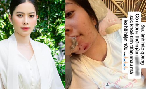 Nam Em lộ gương mặt đầy vết bầm, tiều tụy khó nhận ra