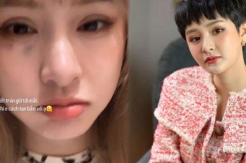 Hiền Hồ lộ diện với vết bầm lớn trên mặt, CĐM nghi ngờ điều này