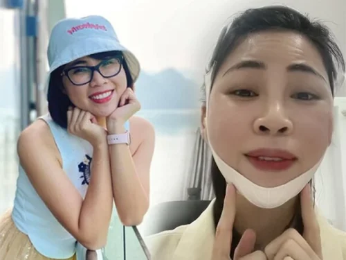 Thơ Nguyễn tháo sụn mũi dù mới dao kéo, nhan sắc hiện tại gây choáng váng