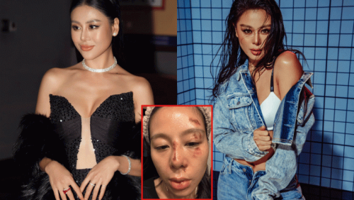 Nam Thư gây xôn xao khi xuất hiện với gương mặt đầy thương tích sau khi bị tố tiểu tam