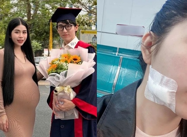 Em trai Hằng Du Mục làm lộ hiện trạng vết thương của chị gái hậu ly dị Tôn Bằng